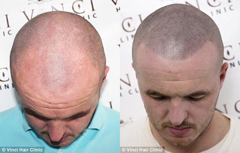 對許多男士來說，禿頭或是光頭都會造成他們缺乏自信心。不過呢，經由最新「頭皮刺青」技術，不需要動手術，你就可以擁有一個平頭的「錯覺」了。