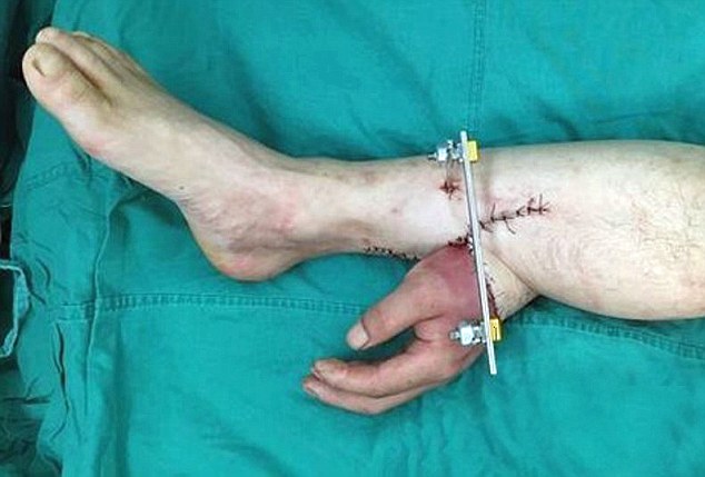 Pic shows: Doctors saved a mans severed hand by attaching it to his leg  Doctors performed an extraordinary operation to save a mans severed hand by attaching it to his leg. A month later they successfully grafted it back onto the factory workers arm after the nerves and tendons had healed from the trauma. The rare operation was performed at a hospital in Changsha, capital of Hunan Province in central China. It happened after worker Zhou had his left hand chopped off during a work accident involving a spinning blade machine.  He was rushed to the Xiangya Hospital in Changsha where doctors assessed his situation. Doctor Tang Juyu, head of microsurgery at the hospital, decided he could give Zhou a chance to "revive" his lost hand - with an operation he and his team had already successfully performed once in 2013 under similar circumstances. Because both Zhous arm and severed hand were badly wounded following the accident, doctors were unable to attach it right away, opting instead to allow the nerves and tendons to heal with time. This meant Doctor Tang and his team decided to graft Zhous left hand to his right ankle. Doctor Tang explained: "Under normal temperatures, a severed finger needs to resume blood supply within 10 hours, but that time is even shorter for a separated limb.  "If a limb is short of blood for too long, its tissues die and it will be unsalvageable." Mr Zhous hand was kept "alive" and left to heal while attached to his ankle for a period of more than one month. Then Doctor Tang and his team successfully reattached it to his arm in a 10-hour surgery. According to the Doctor Tang, Zhou is now able to slightly move his fingers, but he will still need much rehabilitation before regaining full function.