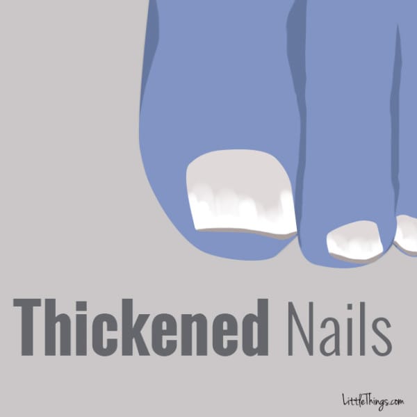 thickenednails