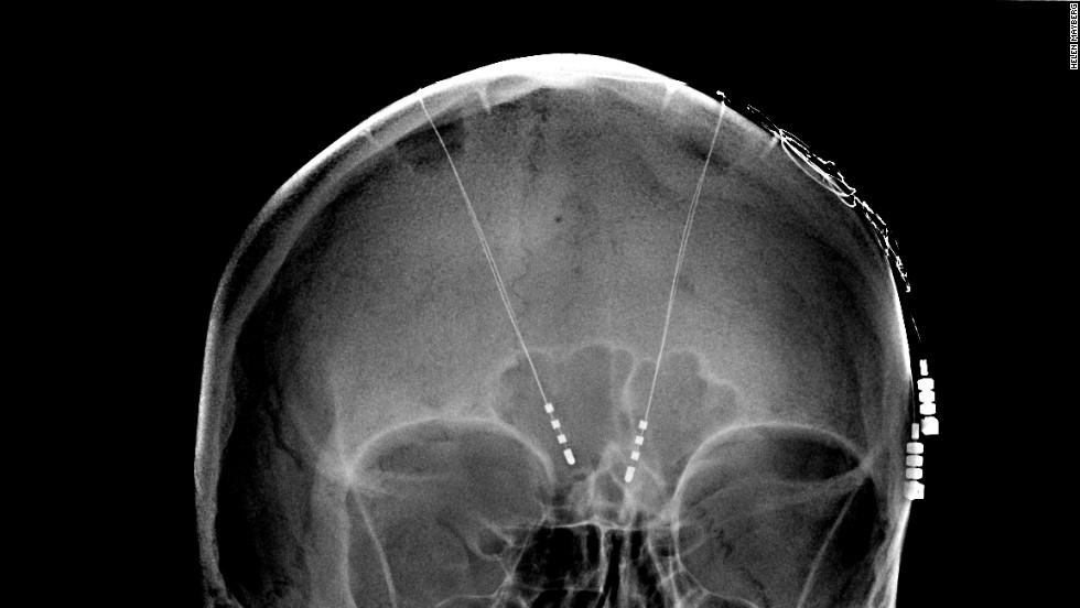130508171349-deep-brain-stimulation-memory-implants-horizontal-large-gallery