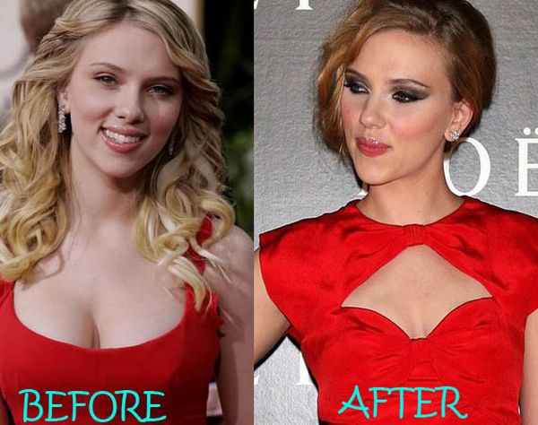 Scarlett-Johansson-breast-reduction-before-after