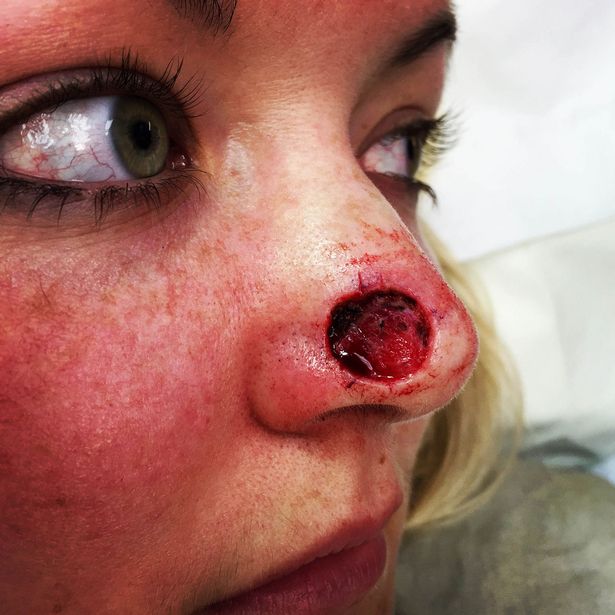 PAY-Woman-with-hole-in-her-nose-from-cancer-1