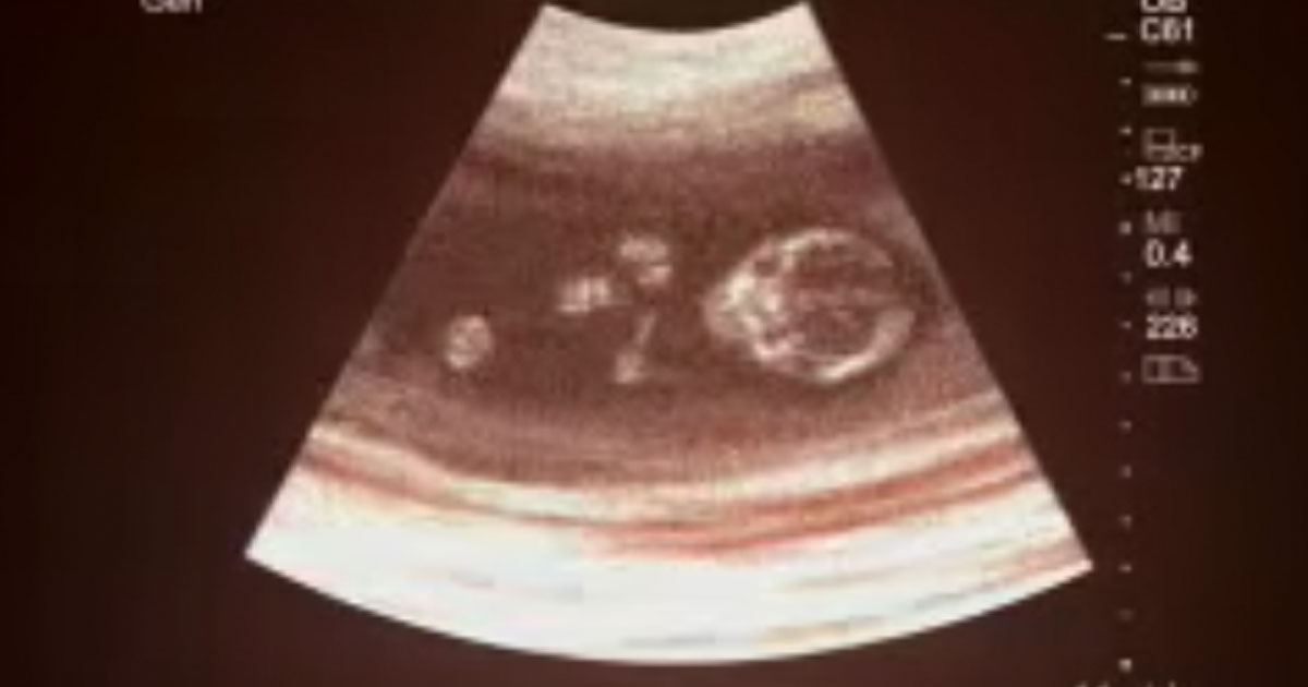 twin_baby_survives_abortion_featured