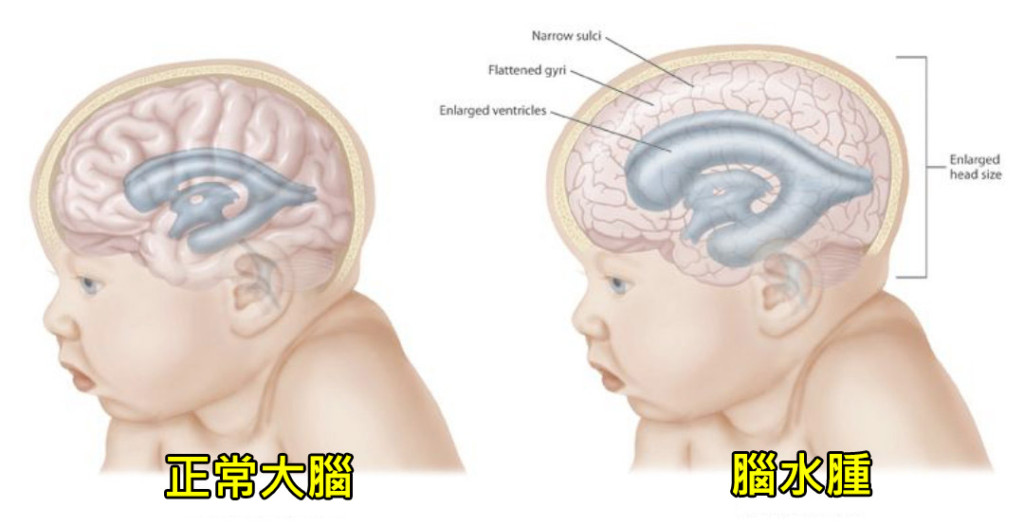 Hydrocephalus_meitu_2