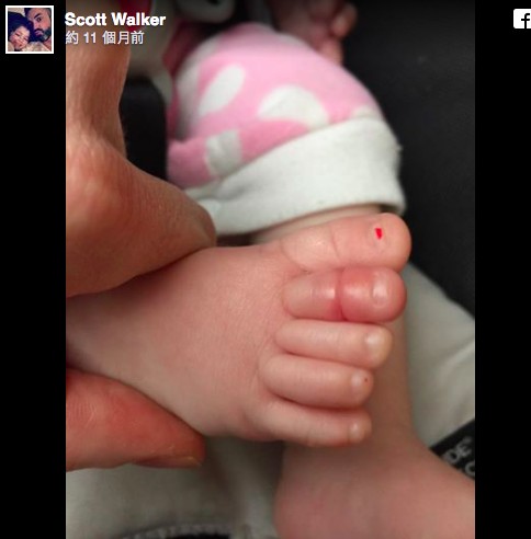 爸媽不解小女嬰為什麼哭不停，「脫下襪子一看」竟差點要截肢保命！