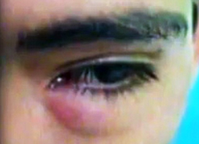 祕鲁有一位17岁的男孩因左眼红肿一个月，吃消炎药都没有用后，进医院做检查发现眼里住了...