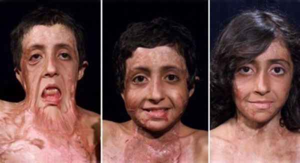 burn-victim-gets-amazing-facial-reconstruction-64450-600x326