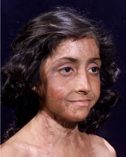 burn-victim-gets-amazing-facial-reconstruction-90944