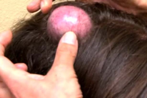 Cyst-Popping