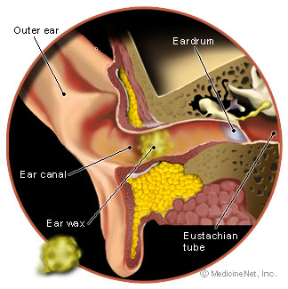 ear_wax