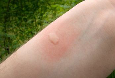 Mosquito-Bite