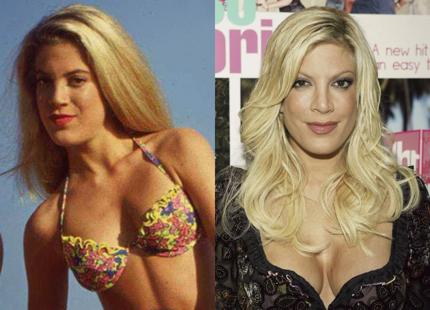 6.-tori-spelling-plastic-surgery