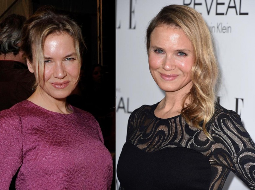 8.-renee-zellweger-plastic-surgery