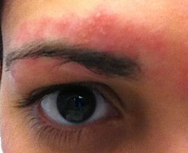 bumps-after-waxing-eyebrows