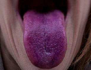 Purple-tongue-Causes-Spots-Under-Tongue-Vein-Baby-Bumps-Symptoms-Chinese-Medicine