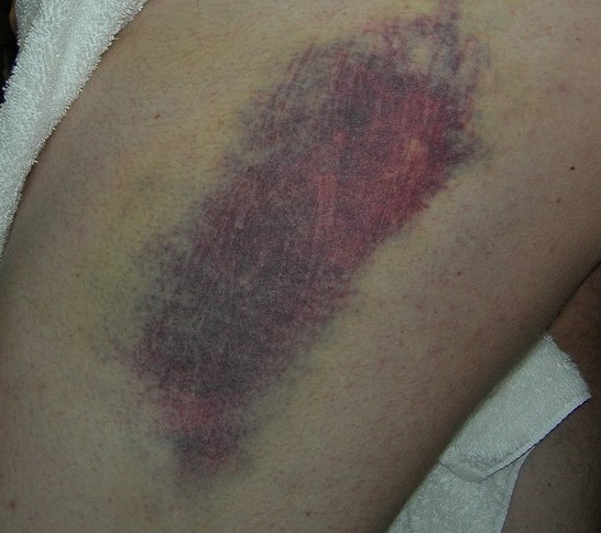 blue-bruise-e1452199923589
