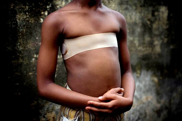 In-Cameroon-there-is-a-tradition-of-ironing-girls-breasts-during-puberty