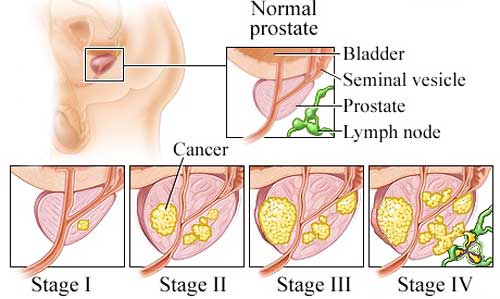 prostate-cancer-metastasis