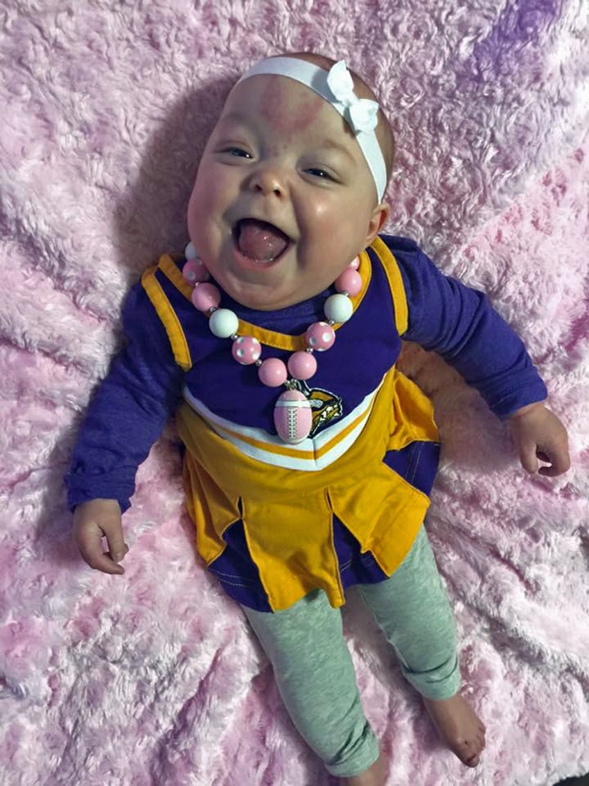 PICS BY MADISON KIENOW / CATERS NEWS - (PICTURED: Here is Paisley now at 16months having had her second tongue reduction surgery six months ago after it grew back - she can now smile and also will be able to say mama and dada for the first time soon) - A baby born with a massive adult-sized tongue has finally been able to smile for the first time after life-changing surgery. Paisley, from Aberdeen in South Dakota, USA, had such a large tongue that she needed breathing apparatus for the first week of her life to stop her from choking to death. She was born with Beckwith Wiedemann Syndrome (BWS)  an overgrowth disorder that affects one in every 11,000 births worldwide. The rare condition caused the little girls tongue to grow more than twice the size of her mouth and it even shocked doctors, who said it was one of the largest tongues they had ever seen. Until she was six months old, Paisley had to be fed via by a gastronomy-tube because she struggled to eat and wasnt receiving the vital nutrients needed to keep her alive. - SEE CATERS COPY
