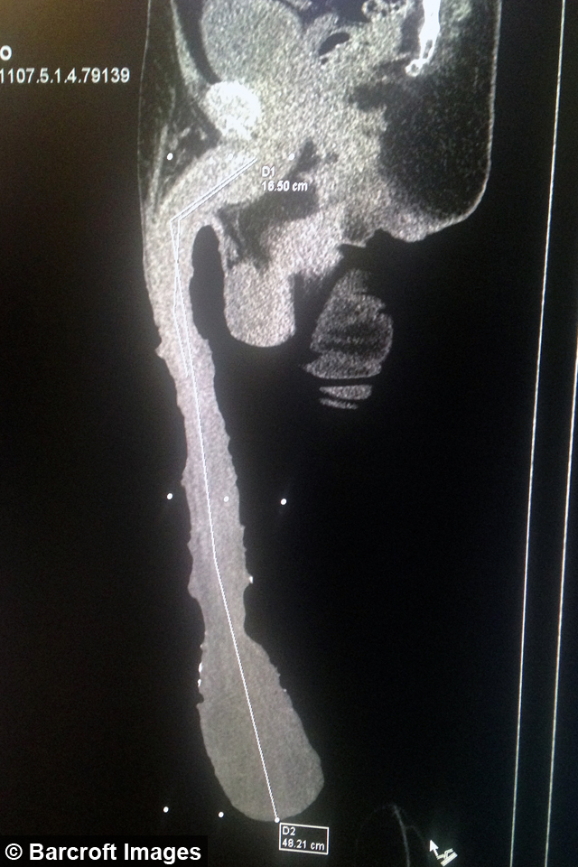 「世界第二長GG男人」被踢爆假的「只有18公分」！醫生公布「灌水30公分方法」狠狠打臉！