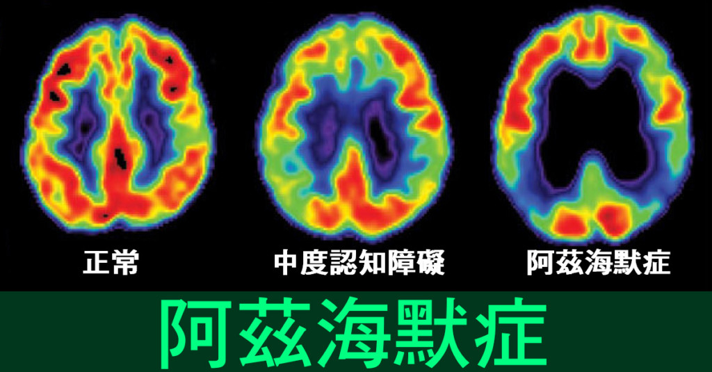 「老年失智」有救了?醫界找到治療重點 專家:明年可有突破性實驗結果!% 照片 「老年失智」有救了?醫界找到治療重點 專家:明年可有突破性實驗結果!